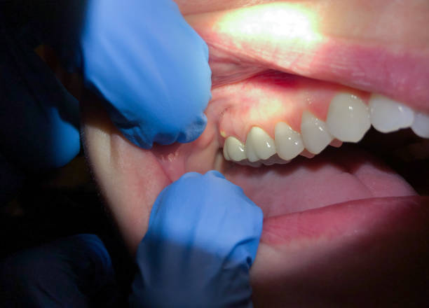 Best Emergency Treatment for Dental Infections or Abscesses in Whitwell, TN
